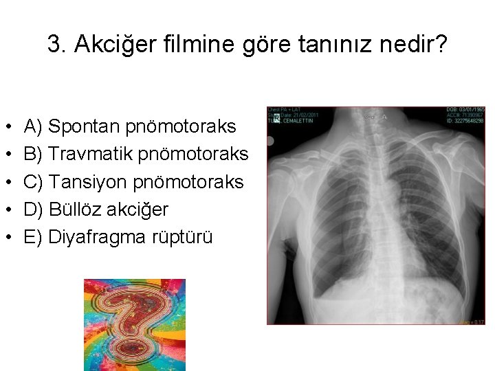 3. Akciğer filmine göre tanınız nedir? • • • A) Spontan pnömotoraks B) Travmatik