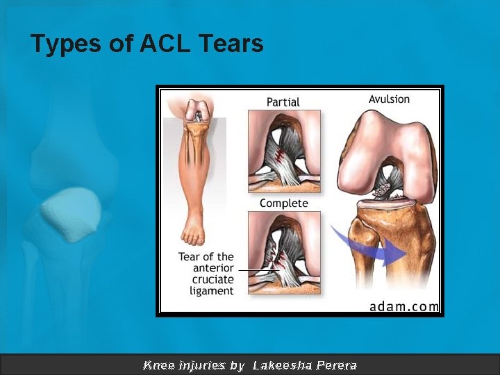 Types of ACL Tears Knee injuries by Lakeesha Perera 