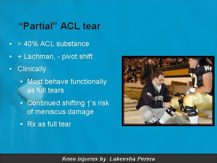 “Partial” ACL tear • > 40% ACL substance • + Lachman, - pivot shift