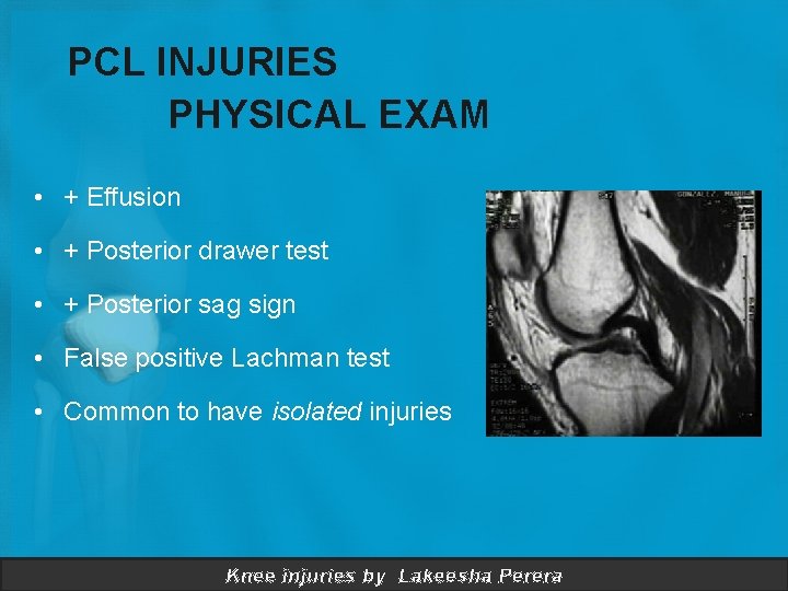 PCL INJURIES PHYSICAL EXAM • + Effusion • + Posterior drawer test • +