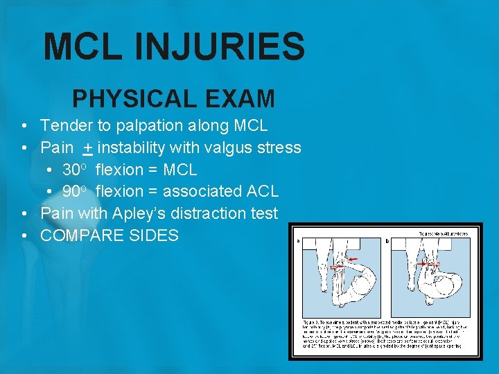 MCL INJURIES PHYSICAL EXAM • Tender to palpation along MCL • Pain + instability