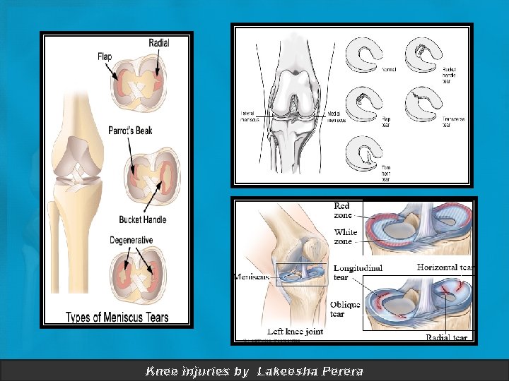 Knee injuries by Lakeesha Perera 