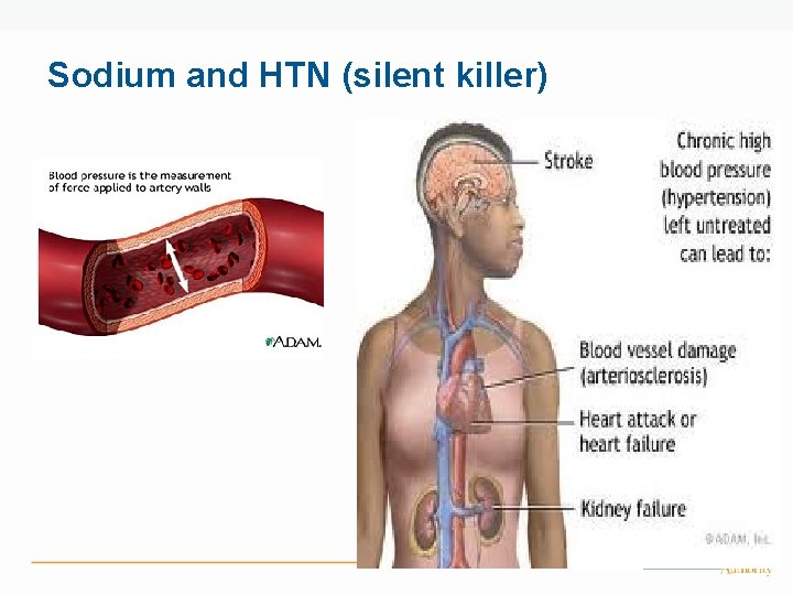 Sodium and HTN (silent killer) 
