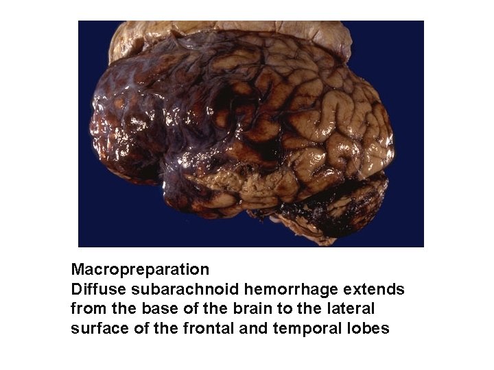Macropreparation Diffuse subarachnoid hemorrhage extends from the base of the brain to the lateral