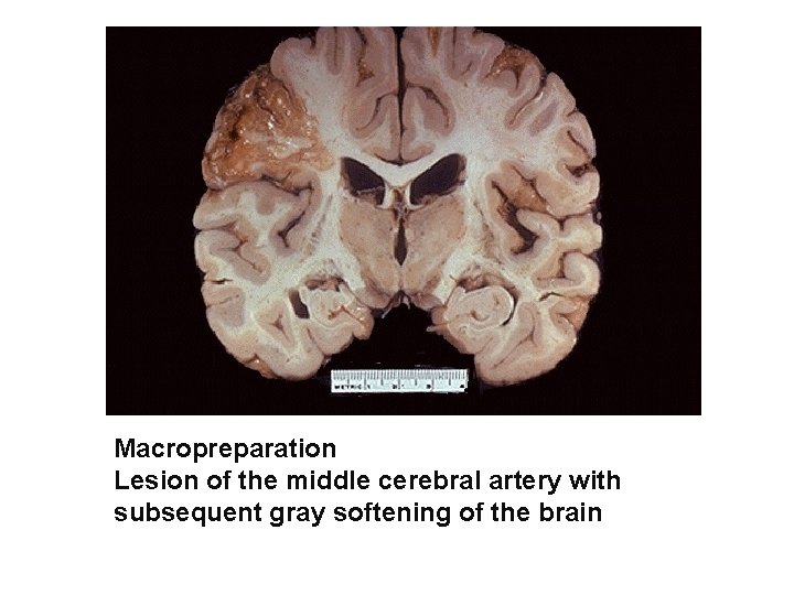Macropreparation Lesion of the middle cerebral artery with subsequent gray softening of the brain