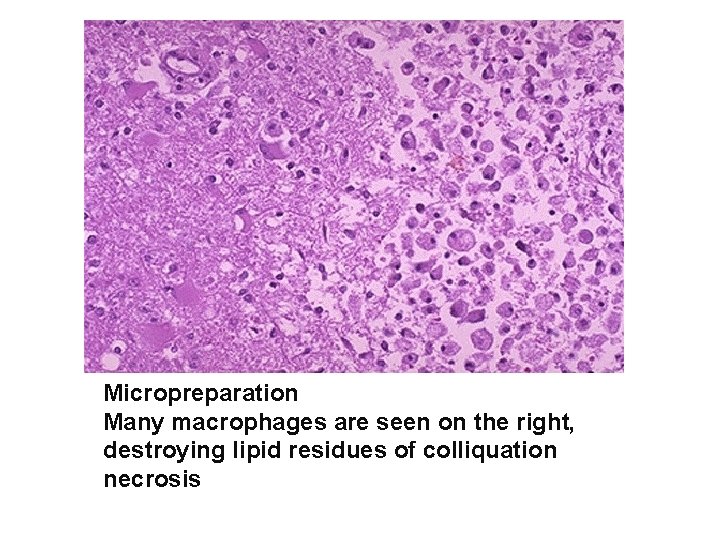 Micropreparation Many macrophages are seen on the right, destroying lipid residues of colliquation necrosis