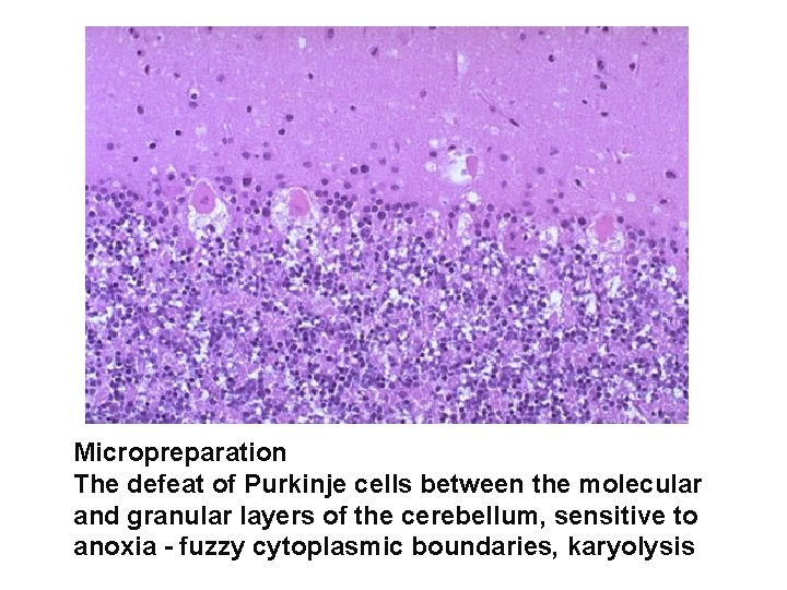 Micropreparation The defeat of Purkinje cells between the molecular and granular layers of the