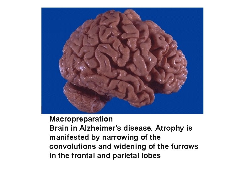 Macropreparation Brain in Alzheimer's disease. Atrophy is manifested by narrowing of the convolutions and