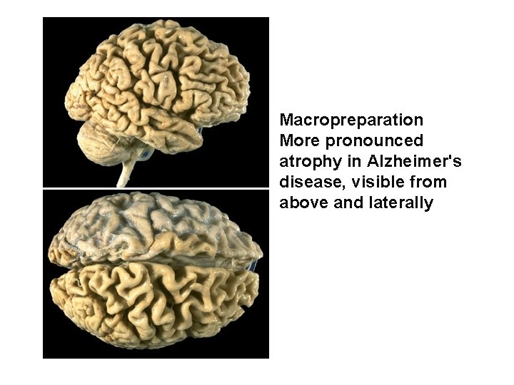 Macropreparation More pronounced atrophy in Alzheimer's disease, visible from above and laterally 