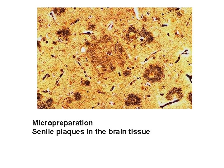 Micropreparation Senile plaques in the brain tissue 