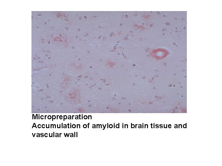 Micropreparation Accumulation of amyloid in brain tissue and vascular wall 