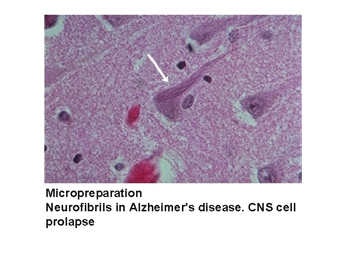 Micropreparation Neurofibrils in Alzheimer's disease. CNS cell prolapse 