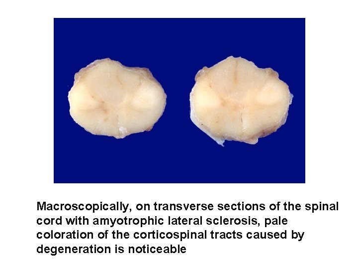 Macroscopically, on transverse sections of the spinal cord with amyotrophic lateral sclerosis, pale coloration