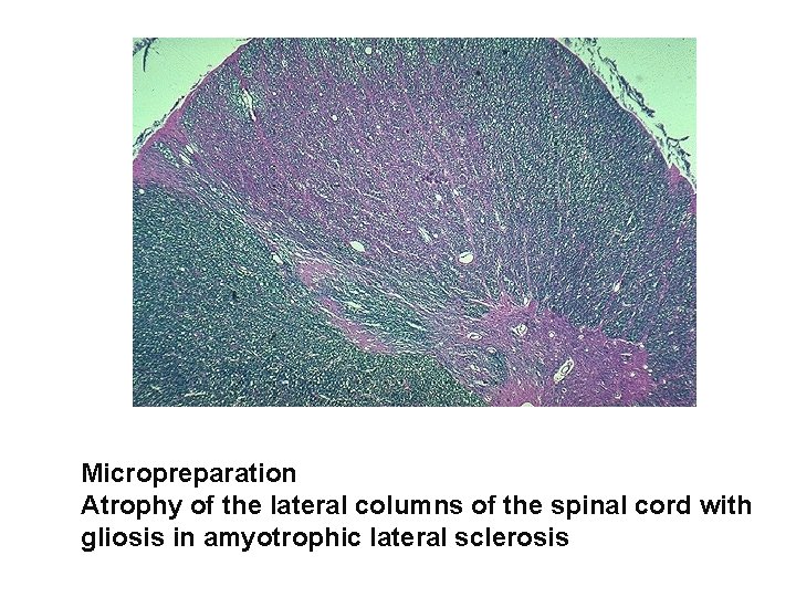 Micropreparation Atrophy of the lateral columns of the spinal cord with gliosis in amyotrophic