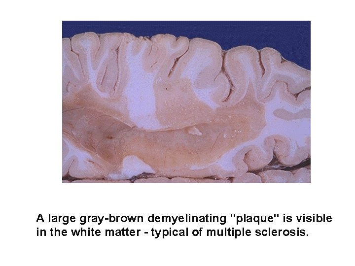 A large gray-brown demyelinating "plaque" is visible in the white matter - typical of