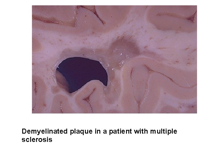 Demyelinated plaque in a patient with multiple sclerosis 