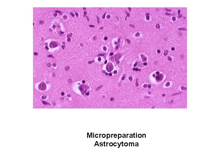 Micropreparation Astrocytoma 