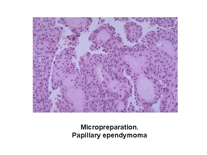 Micropreparation. Papillary ependymoma 