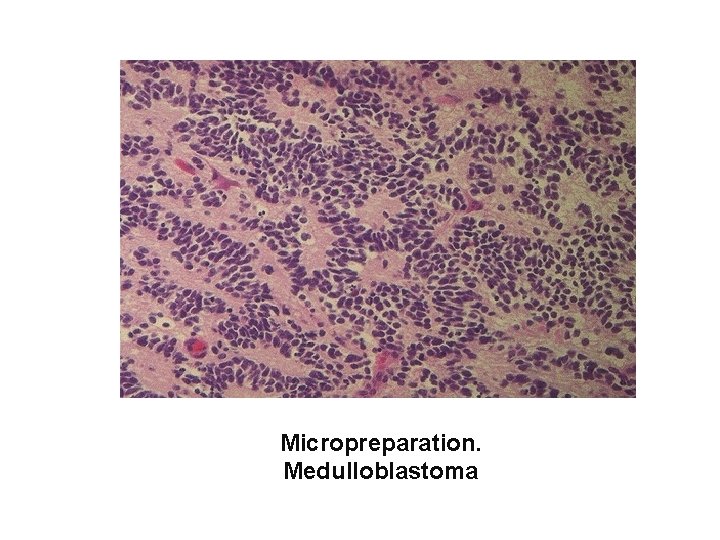 Micropreparation. Medulloblastoma 