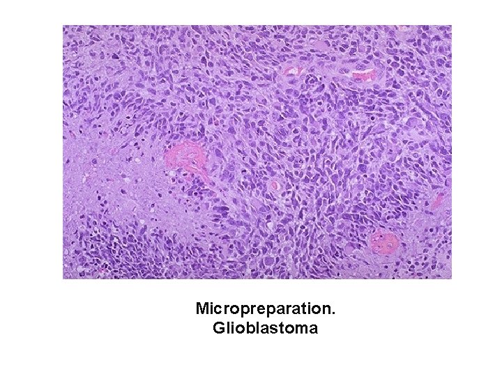 Micropreparation. Glioblastoma 