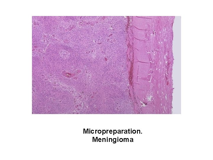 Micropreparation. Meningioma 