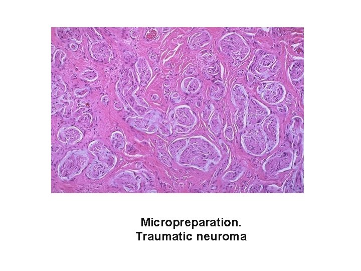 Micropreparation. Traumatic neuroma 