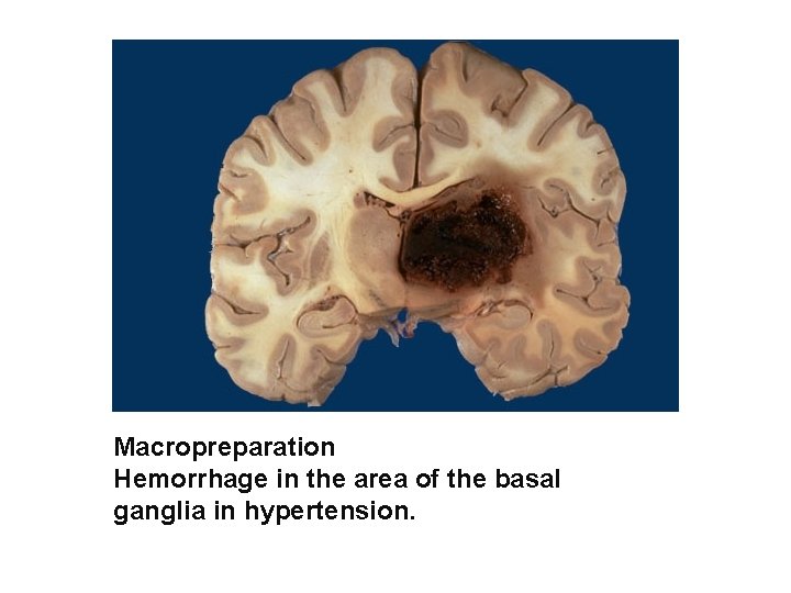 Macropreparation Hemorrhage in the area of the basal ganglia in hypertension. 