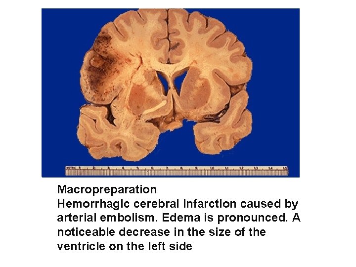 Macropreparation Hemorrhagic cerebral infarction caused by arterial embolism. Edema is pronounced. A noticeable decrease