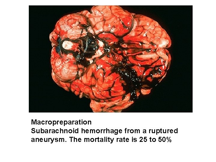 Macropreparation Subarachnoid hemorrhage from a ruptured aneurysm. The mortality rate is 25 to 50%