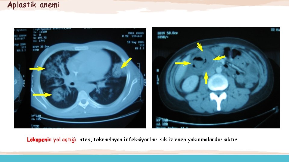 Aplastik anemi Lökopenin yol açtığı ates, tekrarlayan infeksiyonlar sık izlenen yakınmalardır sıktır. 