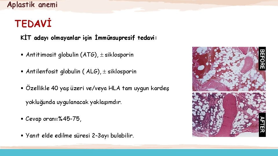 Aplastik anemi TEDAVİ KİT adayı olmayanlar için İmmünsupresif tedavi: § Antitimosit globulin (ATG), siklosporin