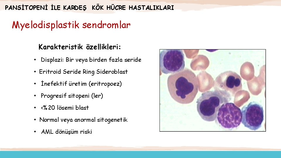 PANSİTOPENİ İLE KARDEŞ KÖK HÜCRE HASTALIKLARI Myelodisplastik sendromlar Karakteristik özellikleri: • Displazi: Bir veya