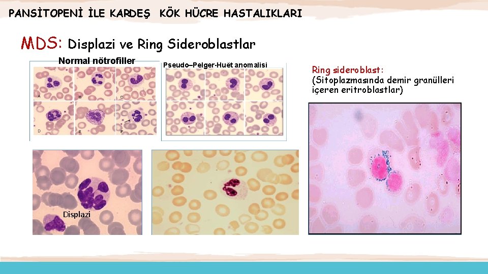 PANSİTOPENİ İLE KARDEŞ KÖK HÜCRE HASTALIKLARI MDS: Displazi ve Ring Sideroblastlar Normal nötrofiller Displazi