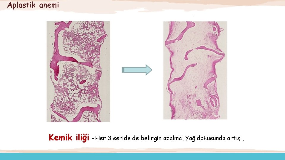 Aplastik anemi Hematopoetik Kök Hücre Kemik iliği – Her 3 seride de belirgin azalma,