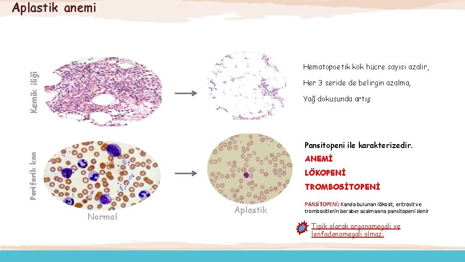 Aplastik anemi Kemik iliği Hematopoetik kök hücre sayısı azalır, Her 3 seride de belirgin