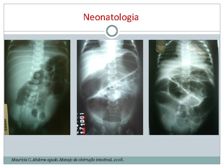 Neonatologia Mauricia C. Abdome agudo. Manejo da obstrução intestinal. 2008. 