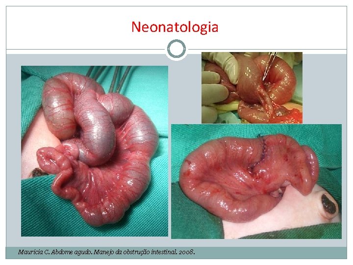 Neonatologia Mauricia C. Abdome agudo. Manejo da obstrução intestinal. 2008. 