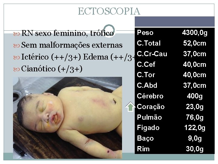 ECTOSCOPIA RN sexo feminino, trófico Peso 4300, 0 g Sem malformações externas C. Total