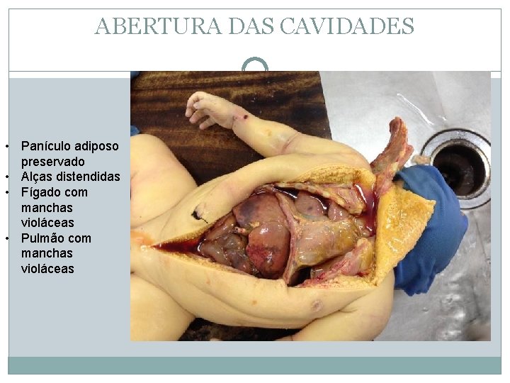 ABERTURA DAS CAVIDADES • Panículo adiposo preservado • Alças distendidas • Fígado com manchas
