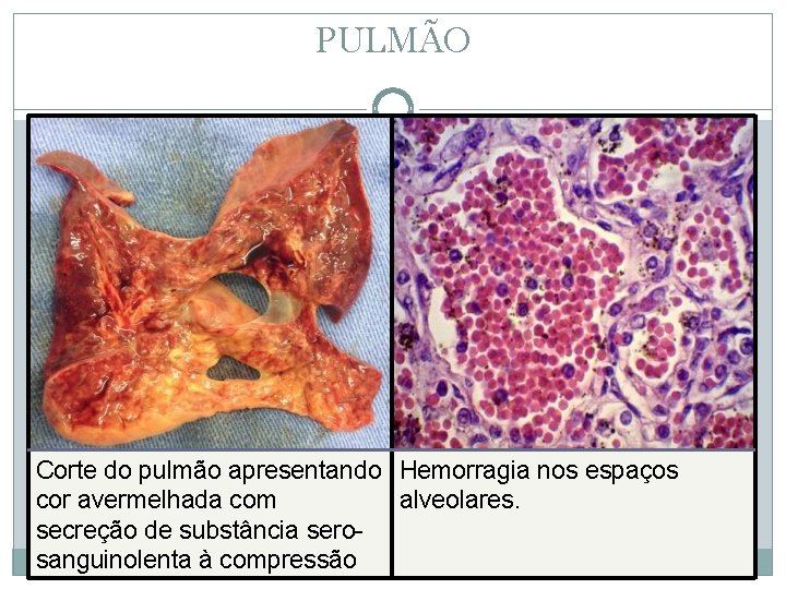 PULMÃO Corte do pulmão apresentando Hemorragia nos espaços cor avermelhada com alveolares. secreção de