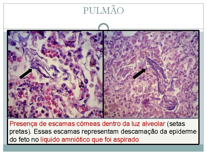 PULMÃO Presença de escamas córneas dentro da luz alveolar (setas pretas). Essas escamas representam