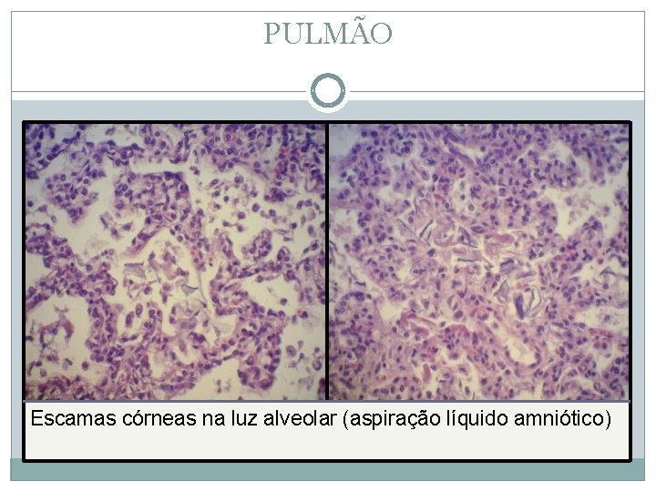 PULMÃO Escamas córneas na luz alveolar (aspiração líquido amniótico) 