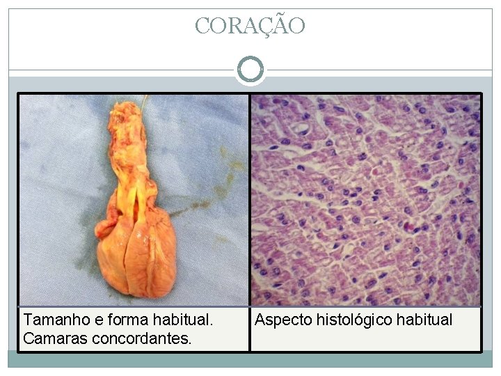 CORAÇÃO Tamanho e forma habitual. Camaras concordantes. Aspecto histológico habitual 