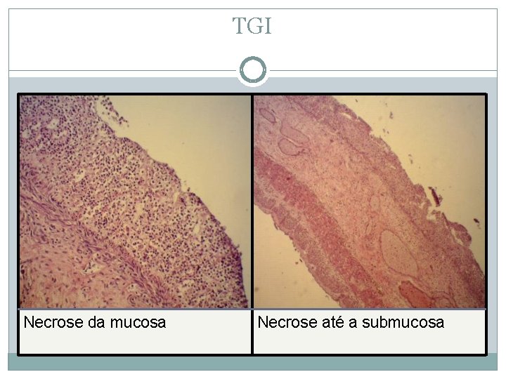 TGI Necrose da mucosa Necrose até a submucosa 