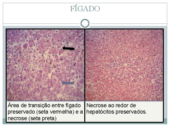 FÍGADO Área de transição entre fígado Necrose ao redor de preservado (seta vermelha) e