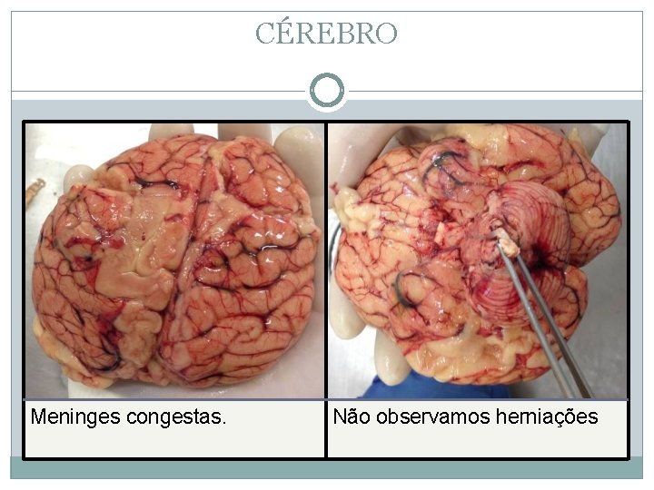 CÉREBRO Meninges congestas. Não observamos herniações 