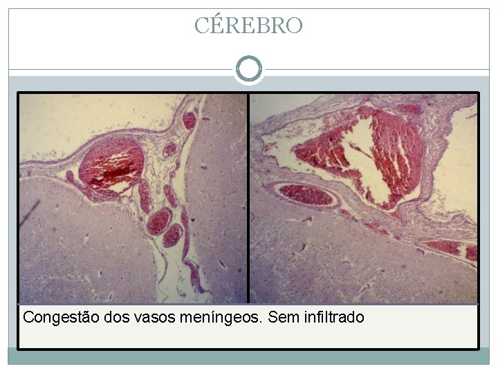 CÉREBRO Congestão dos vasos meníngeos. Sem infiltrado 