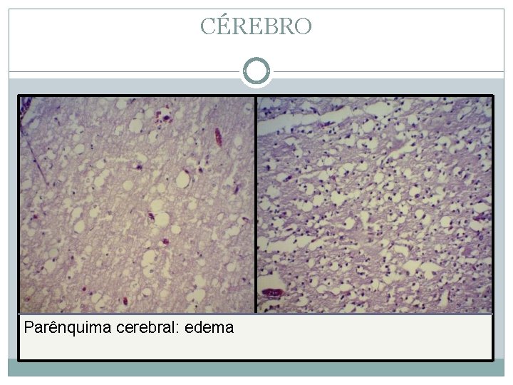 CÉREBRO Parênquima cerebral: edema 