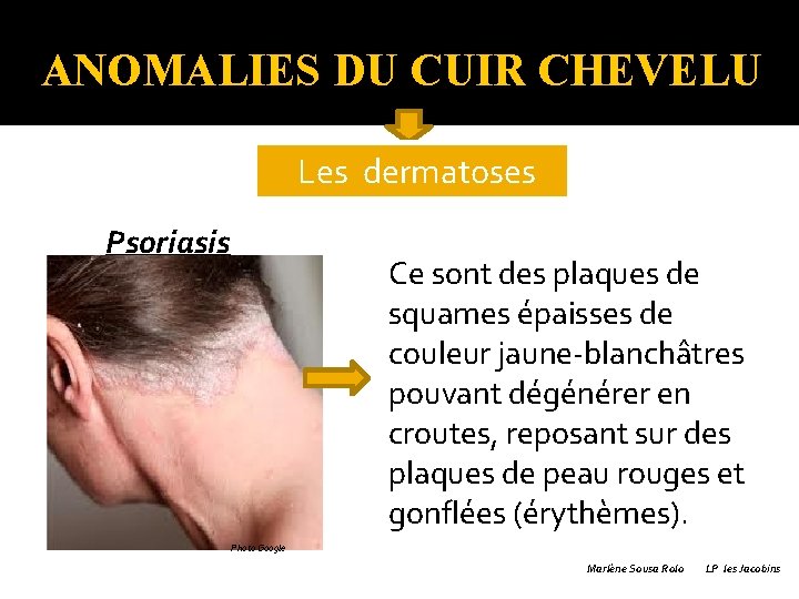 ANOMALIES DU CUIR CHEVELU �Les Psoriasis dermatoses Ce sont des plaques de squames épaisses