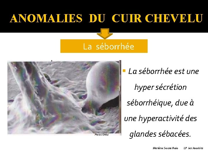 ANOMALIES DU CUIR CHEVELU �La séborrhée § La séborrhée est une hyper sécrétion séborrhéique,